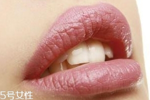 冬天烂嘴角是什么原因,冬天为什么嘴角老是烂