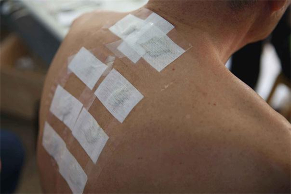 三伏贴有用吗效果好吗,三伏贴的作用功效及适用人群