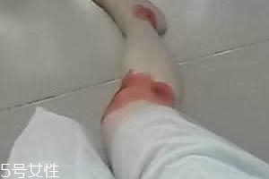 摔伤后的疤痕用什么药膏比较好?,摔伤用什么药好得快