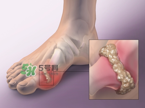 艾艾贴能治痛风吗,痛风发作能用艾灸贴吗 艾艾贴能治痛风吗,痛风发作能用艾灸贴吗