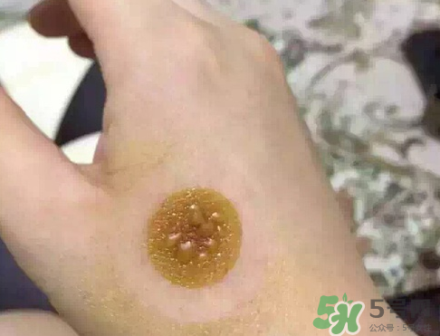 艾灸贴出了水泡是怎么回事?,艾灸贴贴后起水泡怎么办