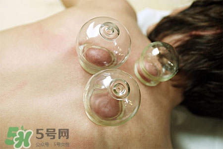 拔罐放血后要注意什么,拔罐放完血需要注意什么 拔罐放血后要注意什么,拔罐放完血需要注意什么