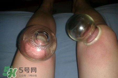 腿部拔罐位置,腿上拔罐应该拔什么位置