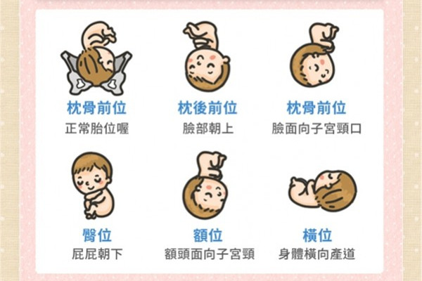什么是胎位不正,什么是胎位不正图