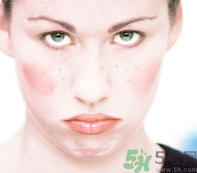 出汗脸痒是怎么回事,出了汗脸上痒怎么回事