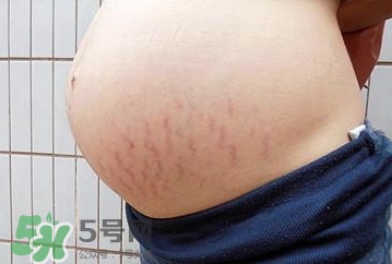 引产后妊娠纹什么时候消失,妊娠纹什么时候消失?