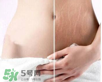 妊娠纹会长在大腿上吗,妊娠纹长大腿上怎么回事