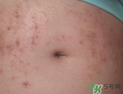 怀孕6个月肚子上长红点点是怎么回事不痒,怀孕6个月肚子上有红点怎么回事