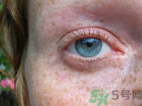 孕妇长斑怎么改善,怀孕期间长斑怎么办 孕妇长斑怎么改善,怀孕期间长斑怎么办