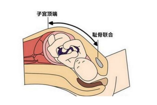 孕妇测量宫高怎么测,怀孕测量宫高是什么意思