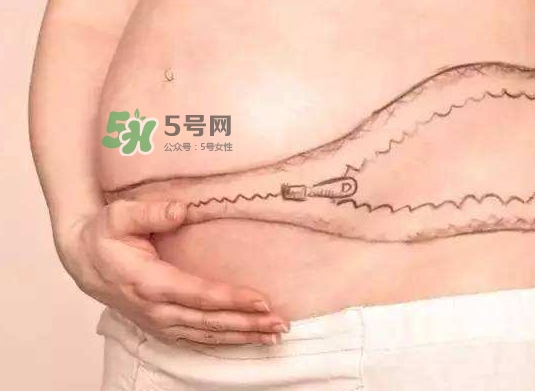 剖腹产的疤痕怎么去掉,剖腹产手术疤痕怎么去除