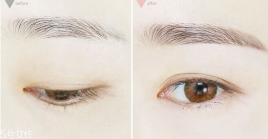 黑眼圈怎么去掉(黑眼圈怎么去掉最快)