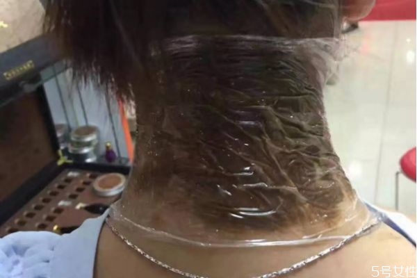 治疗富贵包的方法有哪些(如何消除富贵包) 治疗富贵包的方法有哪些(如何消除富贵包)