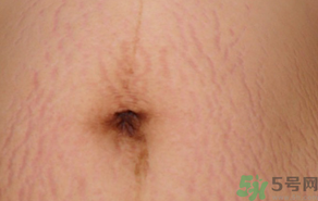 蛋清可以去除妊娠纹吗,鸡蛋清去妊娠纹多久有效果