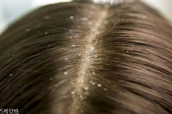 造成头皮屑的原因是什么,产生头皮屑原因