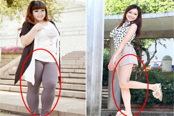 大象腿的危害,大象腿是什么原因引起的 大象腿的危害,大象腿是什么原因引起的