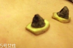 三九灸哪些部位,三九灸是什么