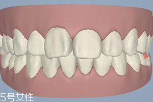 磨牙有哪些症状,磨过牙以后有什么症状