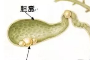 胆囊结石没有任何症状,对于无症状的胆囊结石,有哪些情况