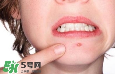 祛痘印的日常方法小妙招,痘印怎么去除简单方法