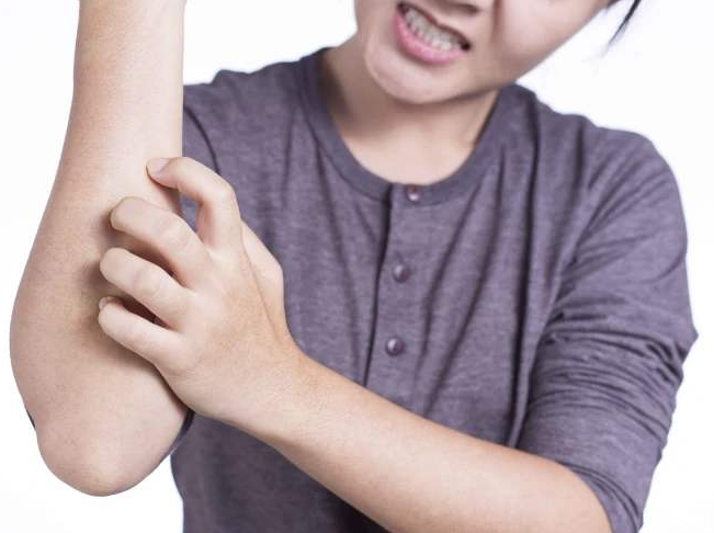 荨麻疹检查需要空腹吗?,过敏性荨麻疹检查需要空腹吗