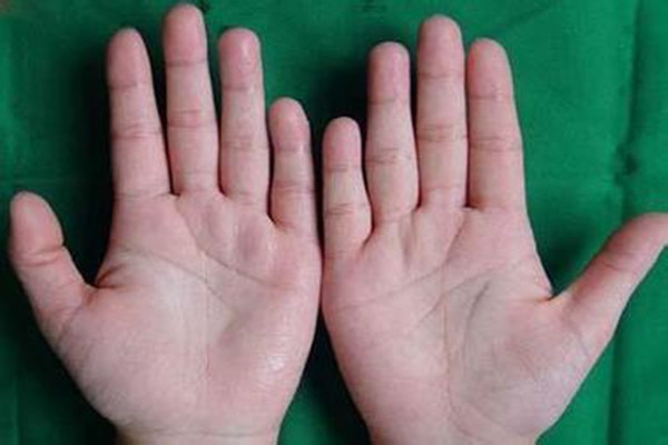 手汗症会自愈吗,手汗症自愈有什么前兆