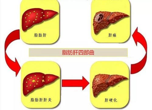 脂肪肝不能吃肉了吗,脂肪肝什么肉不能吃