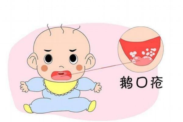 什么是鹅口疮症状图片,宝宝得了鹅口疮总是反复怎么办