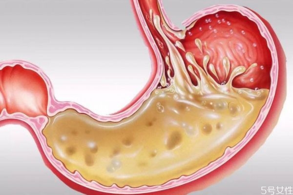胃酸是什么原因造成,产生胃酸的原因
