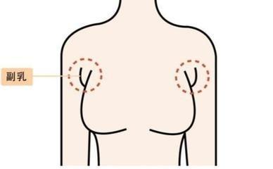 什么是副乳 副乳的图片,什么叫副乳