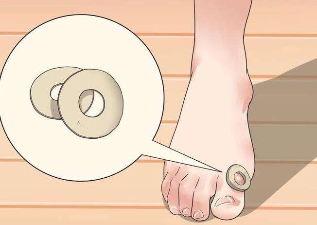 鸡眼是什么原因引起的,鸡眼是什么样的