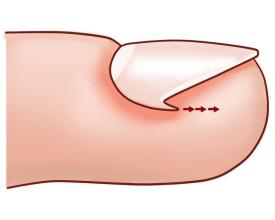 怎么预防嵌甲,嵌甲怎么治疗最好