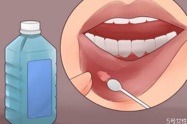 口腔溃疡多长时间能自愈,口腔溃疡多久痊愈