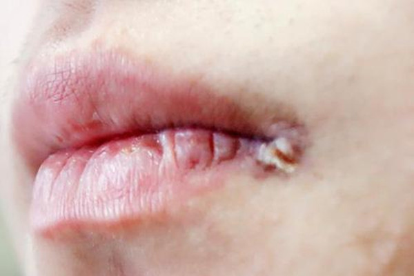 嘴角起泡需要把泡弄破吗,嘴角长泡可以弄破吗 嘴角起泡需要把泡弄破吗,嘴角长泡可以弄破吗