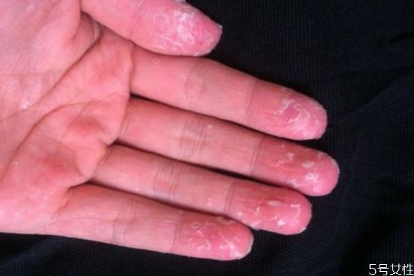 手脱皮是因为什么原因引起的,手上为啥会脱皮