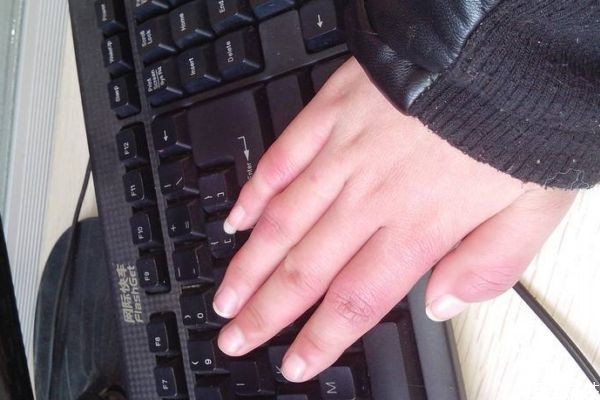 怎么预防冻疮,有什么办法可以预防冻疮