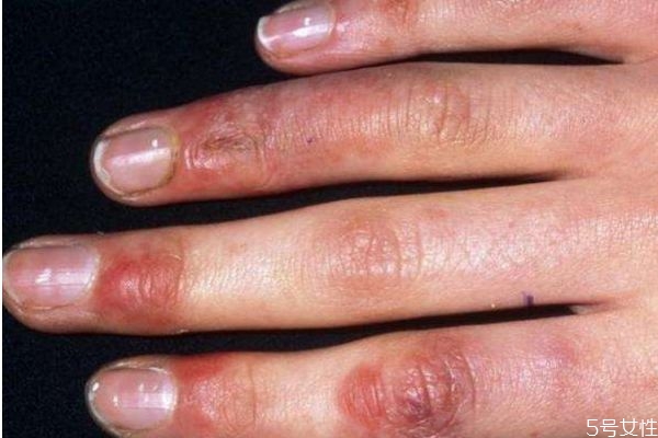 冻疮是如何引起的,冻疮是什么原因造成的