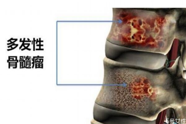 什么原因导致骨髓瘤,什么原因引起骨髓肿瘤