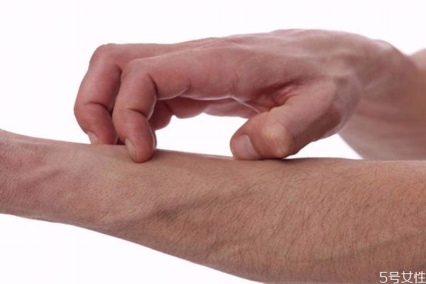 湿疹有些什么症状,湿疹主要有什么症状 湿疹有些什么症状,湿疹主要有什么症状