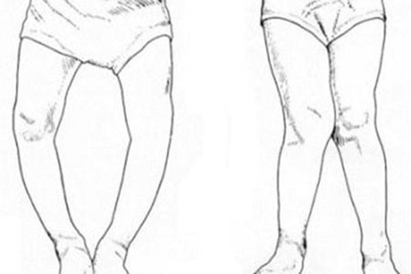 佝偻病是啥症状?什么原因造成的?,什么会引起佝偻病