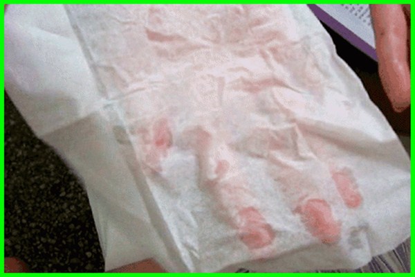 如何治疗多汗症,多汗症是什么原因引起的