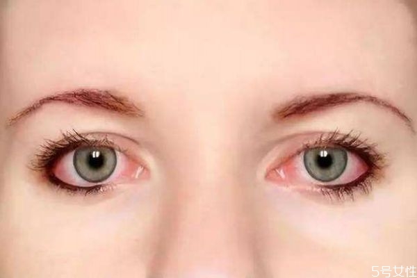 红眼病是怎么引起的,红眼病是什么原因造成的