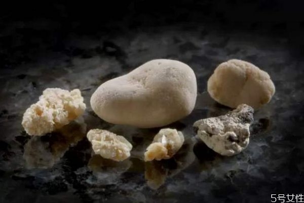 肾结石可以预防吗,肾有结石怎样预防