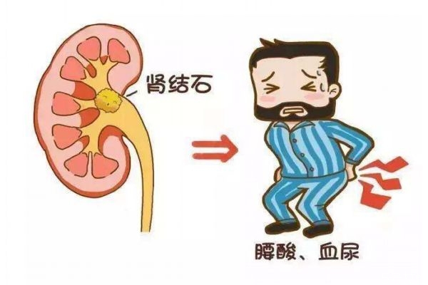 肾结石是一种什么病严重吗,肾结石是啥病
