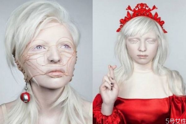 白化病是怎么造成的,白化病是什么原因引起的