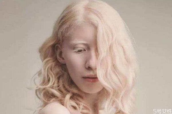 什么是白化病呢,啥是白化病?