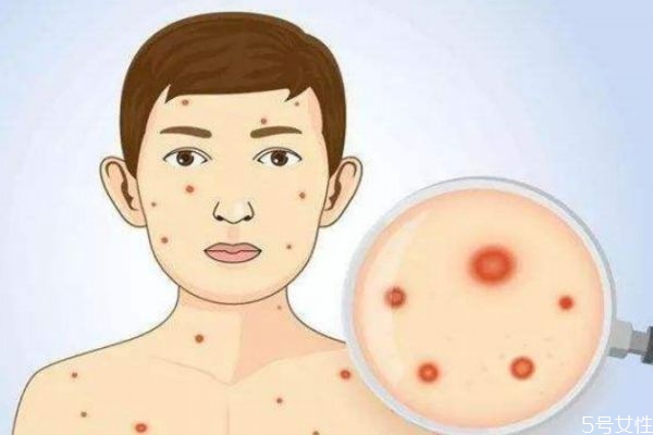 怎样治疗水痘,水痘如何治愈