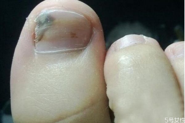灰指甲怎么造成的,灰指甲是怎么有的
