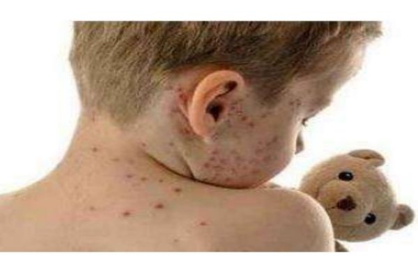 身体长水痘是什么原因,水痘怎样才能好