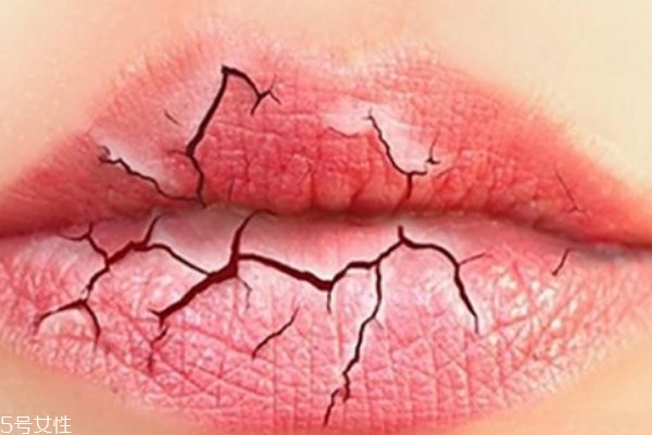 为什么冬天嘴唇起皮,冬天嘴起皮是什么原因
